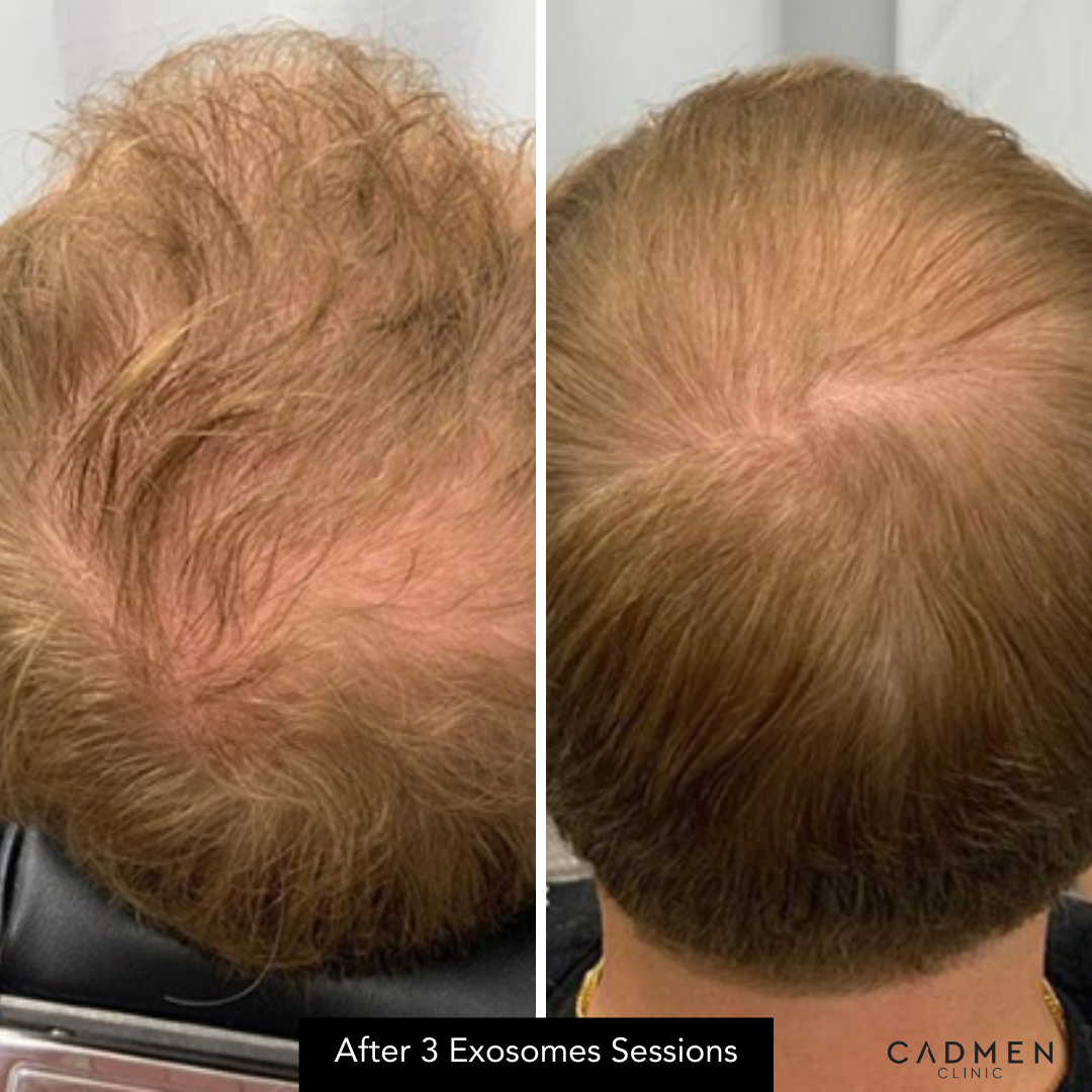 Exosome Hair Therapy before and after