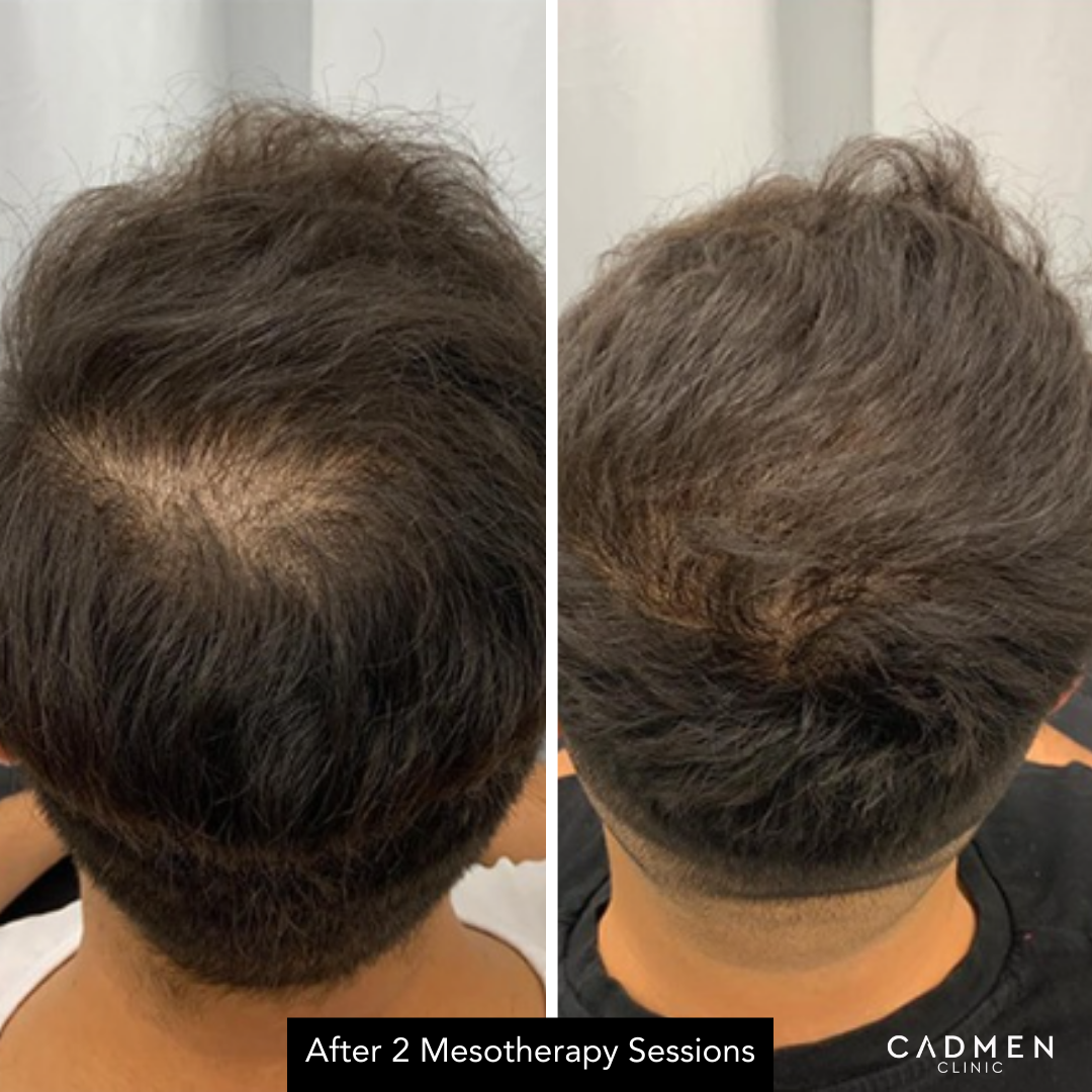 Mesotherapy Vitamins before and after