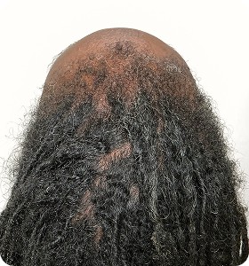 Female 43 after