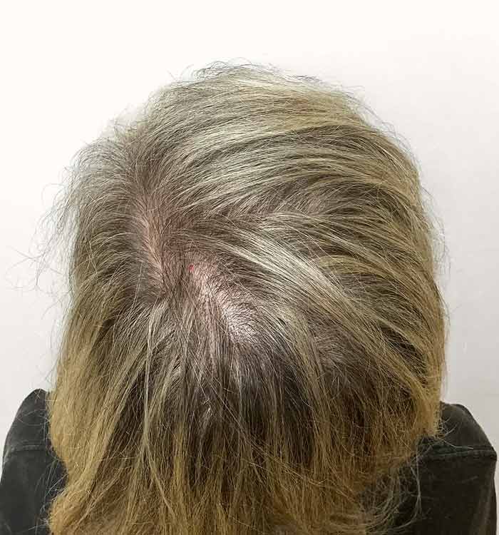 Female 44 after