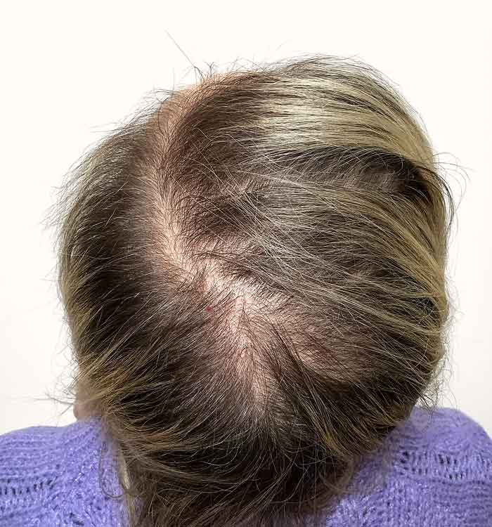 Female 44 before