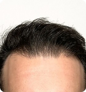 Male 29 after