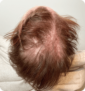 Female 52 before
